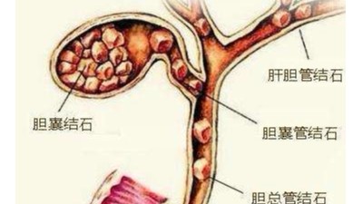 膽囊結(jié)石可以不切膽嗎？