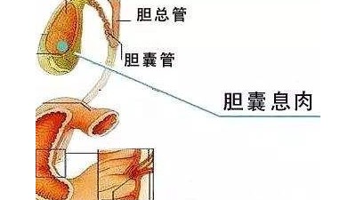 雅安治療膽囊息肉